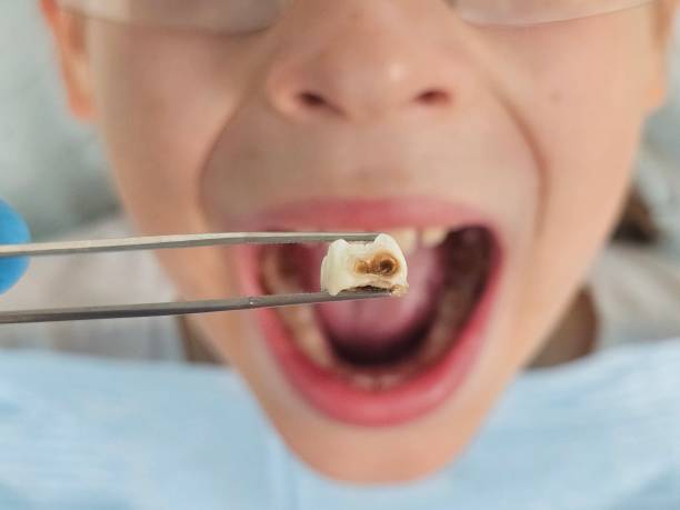 Best Emergency Tooth Extraction in Holly Ridge, NC